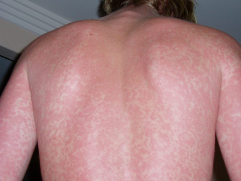 A man with red spots on his back and chest.