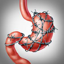 A drawing of an intestinal loop with barbed wire around it.